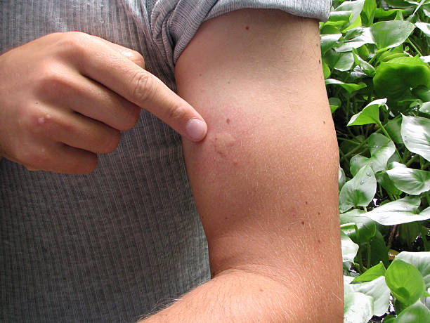 Mosquito bite Finger pointing a mosquito bite on the arm. stinging stock pictures, royalty-free photos & images
