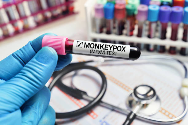 Doctor with a blood sample in a tube diagnosed with Monkeypox (MPXV) disease stock photo
