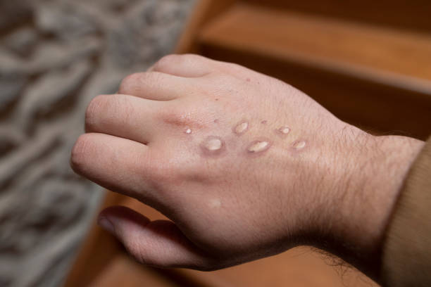 Monkey pox rash Monkey pox vesicles in a hand pox stock pictures, royalty-free photos & images