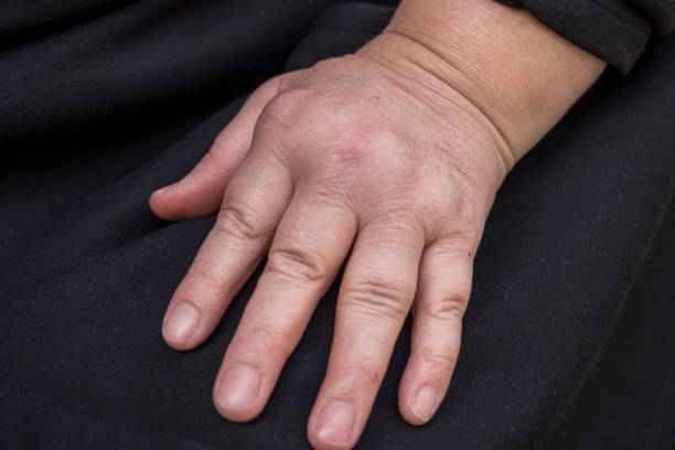 Hand Of Woman Deformed From Rheumatoid Arthritis. a chronic progressive disease causing inflammation in the joints and resulting in painful deformity and immobility.