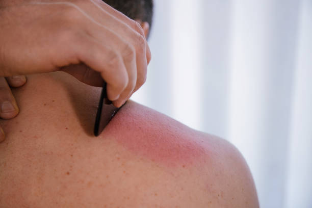 therapist doing skin scrape technique. concept of chinese technique, gua sha, for pain relief and treatment and activating blood circulation. stimulus therapy. - alternative therapy massaging clinic health spa imagens e fotografias de stock