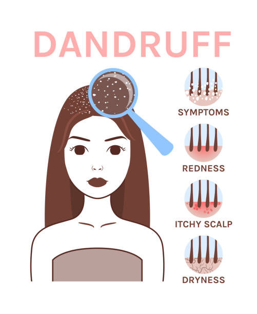 Symptoms of Dandruff. Woman with Problem Skin on Head. Analysis. Treatment. Magnifying glass and Close Up of Dryness and Redness. Cartoon Line style. White background. Vector image for Medical design. Symptoms of Dandruff. Woman with Problem Skin on Head. Analysis. Treatment. Magnifying glass and Close Up of Dryness and Redness. Cartoon Line style. White background. Vector image for Medical design. symptoms of Dandruff stock illustrations