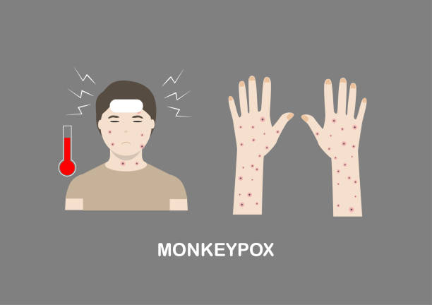 Illustration of monkeypox symptoms Illustration of monkeypox symptoms including fever, headache and rash on face, body and extremities. mpox stock illustrations