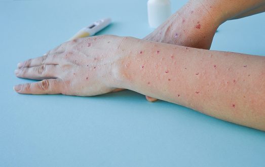 Virus de la viruela del mono, un nuevo problema mundial de la humanidad moderna. Primer plano de las manos de una persona enferma con granos y ampollas. photo