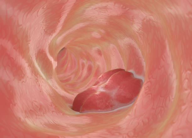 大腸癌 - 大腸癌 ストックフォトと画像
