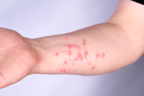 Hand of a young guy in a rash. Monkeypox virus symptoms Hand of a young guy in a rash. Monkeypox virus symptoms. skin condition photos stock pictures, royalty-free photos & images