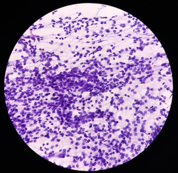 endometriosi cicatriziale (fna), immagine microscopica mostra cellule epiteliali benigne e cellule stromali. - cramping foto e immagini stock