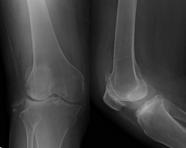 istock Osteoarthritis knee . film x-ray knee 1399335170