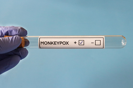 Imagen en primer plano de la prueba de laboratorio de Monkeypox (Poxviridae) tubo de ensayo de vidrio etiquetado sostenido en mano enguantada de látex, fondo azul, vista elevada photo