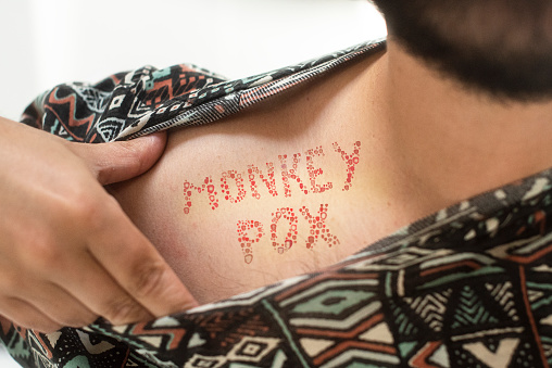 Monkey Pox written as a rash created by the disease on the skin