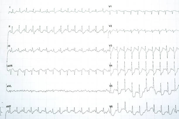 eine positive stressinduzierte myokardischämie mit signifikanten horizontalen st-depressionsänderungen im stress-ekg-elektrokardiogramm-test - pulse trace arrhythmia electrode listening to heartbeat stock-fotos und bilder