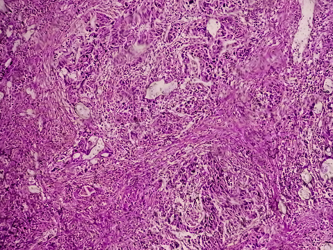 Bladder Cancer: High grade transitional cell carcinoma (TCC), Urothelial carcinoma