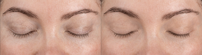 Skin around eyes, eyelids before and after application of care cosmetics or cosmetic procedures, creams, serums, masks. Part face middle-aged woman. Procedure for rejuvenation of wrinkles around eyes