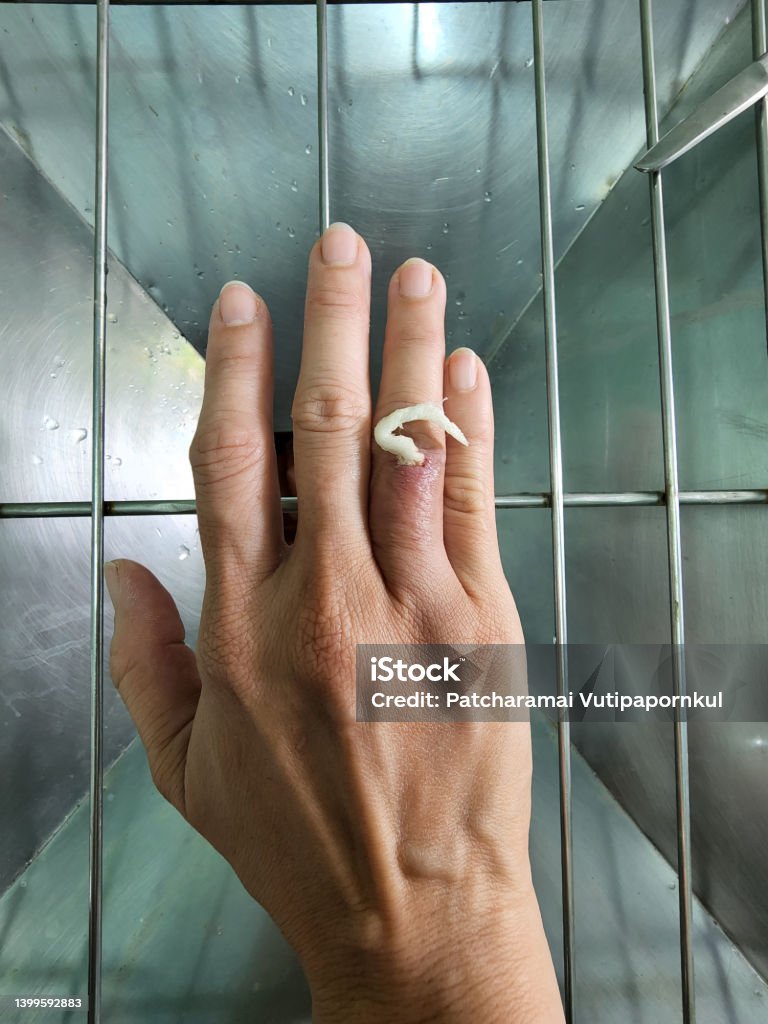 Wash The Open Wound By Inserting Gauze Into The Wound To Prevent It