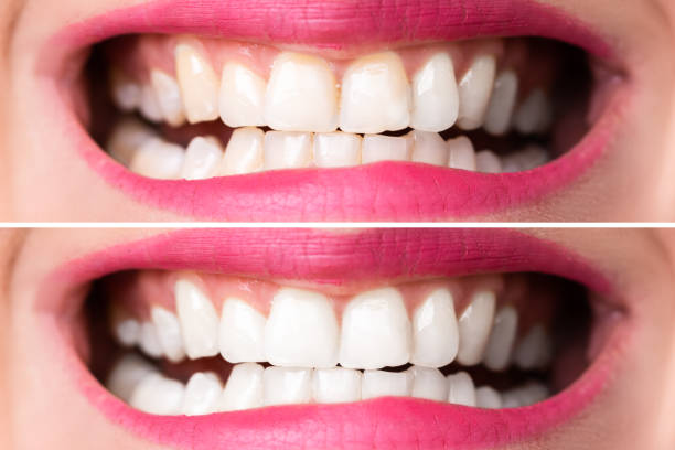 istock Woman's Teeth Before And After Whitening 1399683200