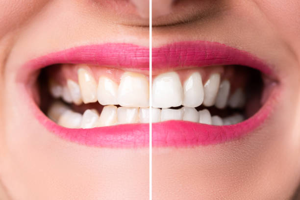 istock Woman's Teeth Before And After Whitening 1399683204