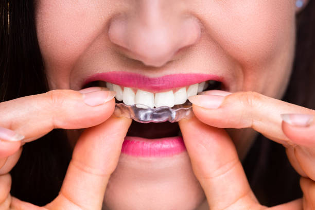 istock Woman Putting Transparent Aligner In Teeth 1399683210