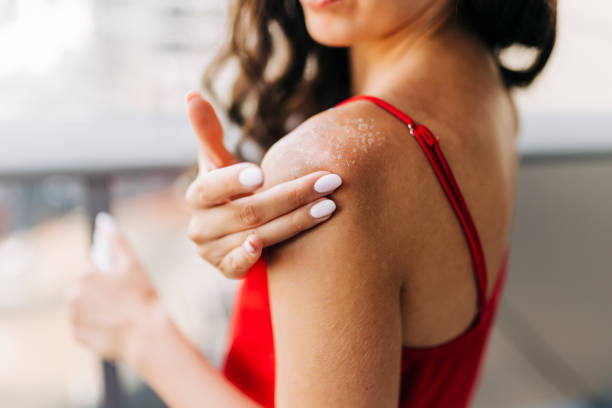 gros plan d’une femme appliquant une crème hydratante sur une peau brûlée par le soleil - caractéristique dermatologique photos et images de collection