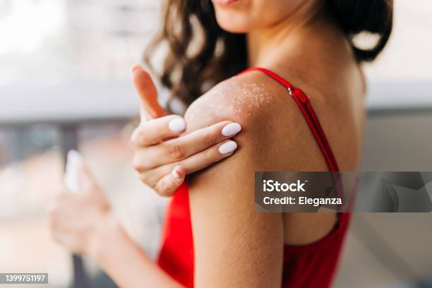 Close Up Of Woman Applying Moisturizer On Sunburned Skin Stock Photo - Download Image Now
