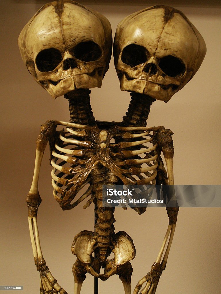 skeleton of conjoined twins KONICA MINOLTA DIGITAL CAMERA. Taken in the medical museum in the University at Buffalo. Human Skeleton Stock Photo