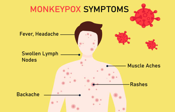 monkeypox virus symptom concept. patient with symptom of monkey pox virus, fever, headache, swollen lymph node, rashes and back, muscle aches  vector illustration - 猴痘 插圖 幅插畫檔、美工圖案、卡通及圖標