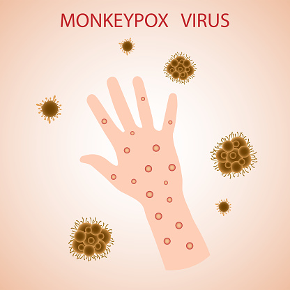 Monkeypox virus on the skin on the arm.  The monkeypox virus is a viral disease that can affect humans and non-human primates. Monkey pox.  A banner to inform and warn about the spread of the disease, symptoms or precautions.Vector illustration