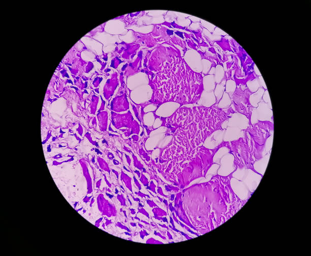 visão miroscópica do estudo de tecido histológico mostrando rabdomyoma. - adductor magnus - fotografias e filmes do acervo