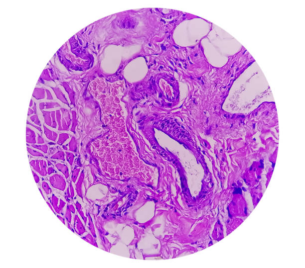 vista miroscópica del estudio histológico del tejido que muestra rabdomioma. - aductor grande fotografías e imágenes de stock