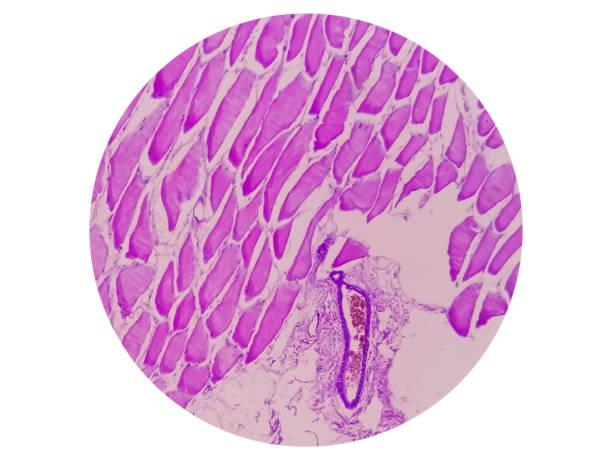 vista miroscópica del estudio histológico del tejido que muestra rabdomioma. - aductor grande fotografías e imágenes de stock