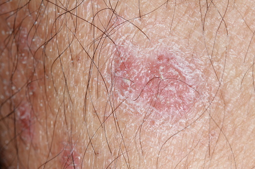 problem skin psoriasis on the body.