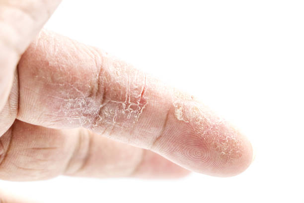 istock index finger skin disease on white background 1400060566
