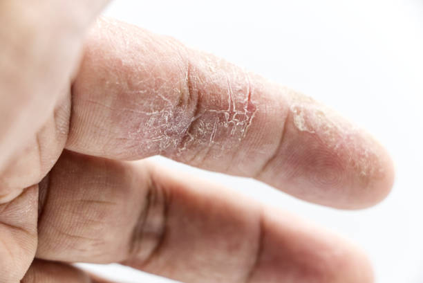 istock index finger skin disease on white background 1400060569