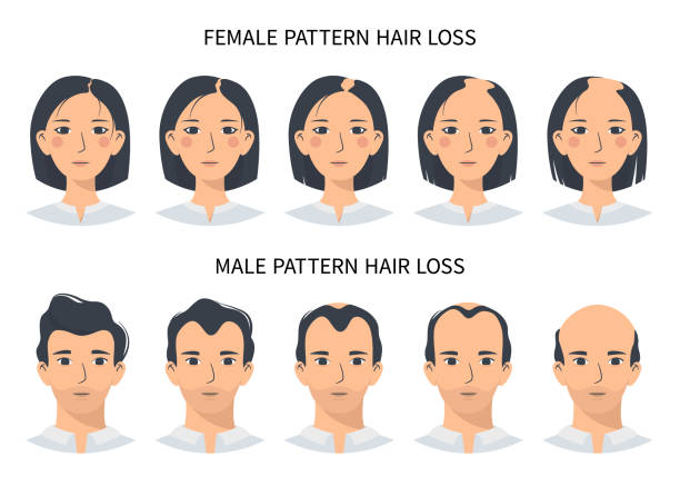 ilustrações, clipart, desenhos animados e ícones de estágios de queda de cabelo, alopecia androgenética padrão masculino e feminino - alopecia antes depois