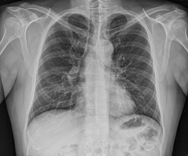 Male front chest xray. stock photo