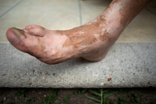 man's leg with vitiligo