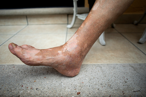 man's leg with vitiligo