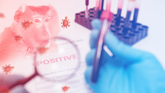 Una lupa que se acerca a la información sobre los resultados de la prueba de viruela del mono en un laboratorio. photo