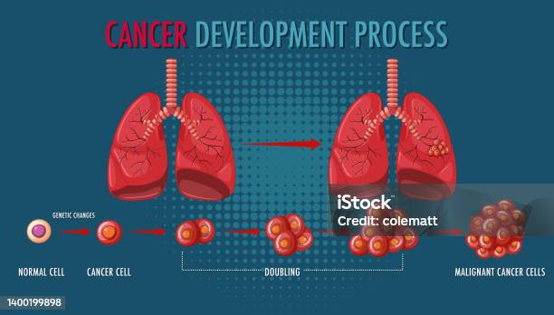 Cancer Development Published Cancer Development Process Infographic Stock Illustration - Download ...