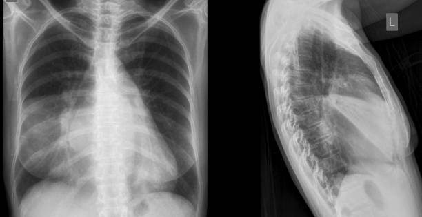 istock Right middle lobe pneumonia x ray 1400223386