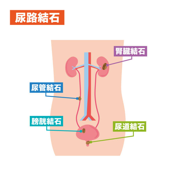 Illustrated illustration of urinary stones Illustrated illustration of urinary stones ureter stock illustrations