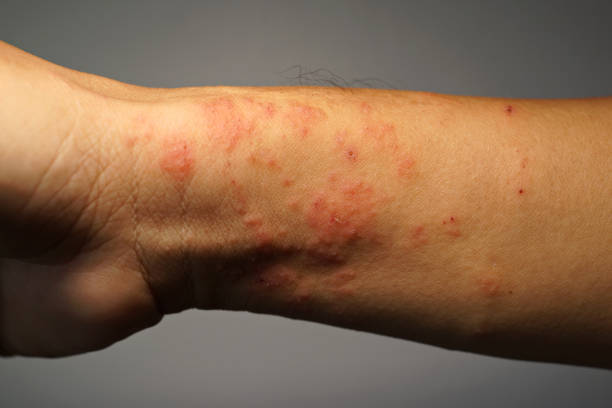 istock Atopic eczema allergy texture of ill human wrist 1400349102