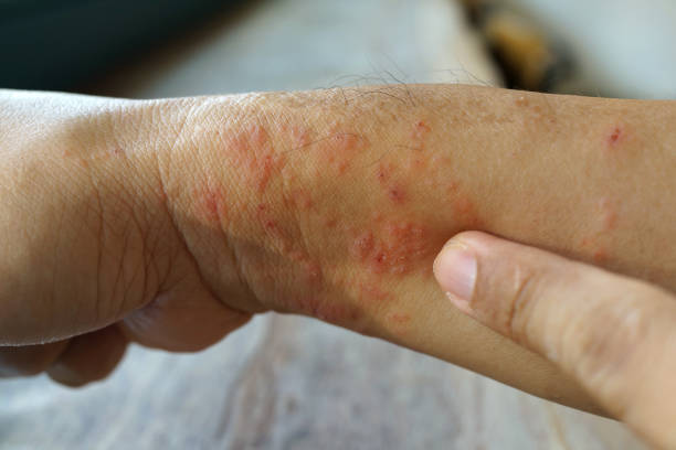Atopic eczema allergy texture of ill human wrist stock photo