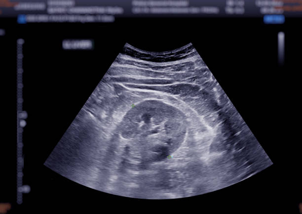 Ultrasound upper abdomen showing  kidney. stock photo