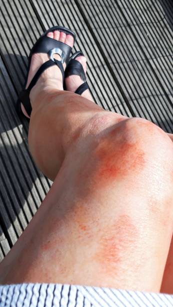 istock Skin disease on the leg 1400391640