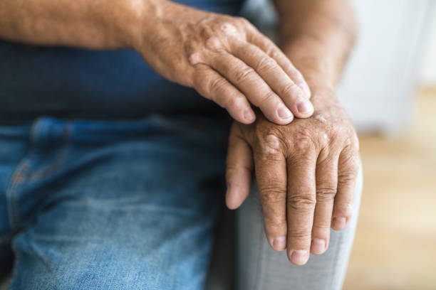 älterer mann, der an psoriasis an den händen leidet - arthritis stock-fotos und bilder