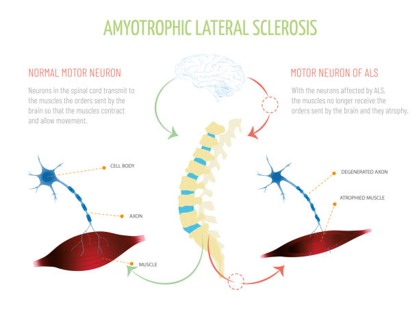 ilustrações de stock, clip art, desenhos animados e ícones de world day for the fight against amyotrophic lateral sclerosis. muscle and neuron on white background .
infographic about amyotrophic lateral sclerosis, what is amyotrophic lateral sclerosis, symptoms, risk factors, general care and treatment.

infographic - esclerose lateral amiotrófica