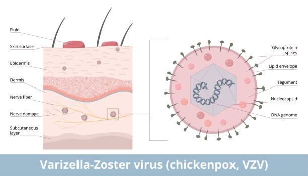 varicella-zoster-virus (windpocken, vzv) - zoster stock-grafiken, -clipart, -cartoons und -symbole