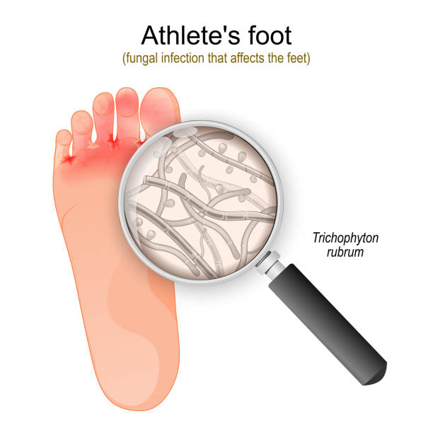 Athlete's foot. fungal infection of Trichophyton Athlete's foot. fungal infection that affects the feet. Close-up of Trichophyton rubrum fungi. vector illustration tinea stock illustrations