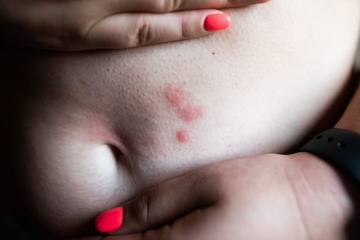 A skin rash in a woman's chest