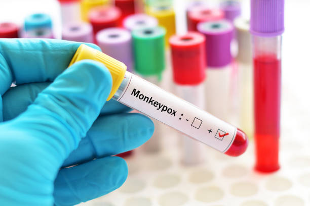 Blood sample positive with Monkeypox stock photo